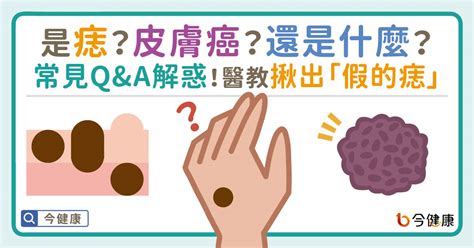 痣 形成原因|是痣？皮膚癌？還是什麼？常見Q&A解惑！醫教揪出「。